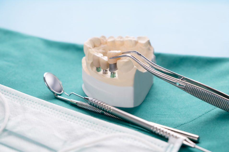 Implant and prosthodontic model.