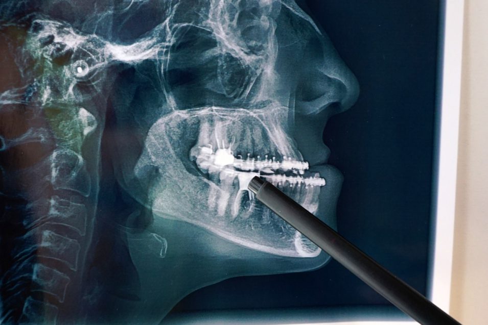 CT scan of teeth with braces in consultation with a maxillofacial surgeon. High quality photo