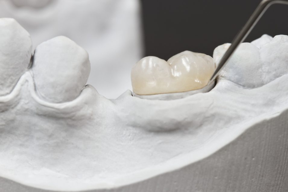 Placement of a dental inlay on a cast model using a tool