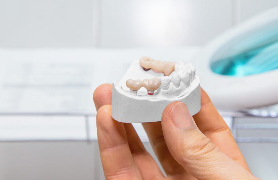 dental bridge model holded by hamilton dentist