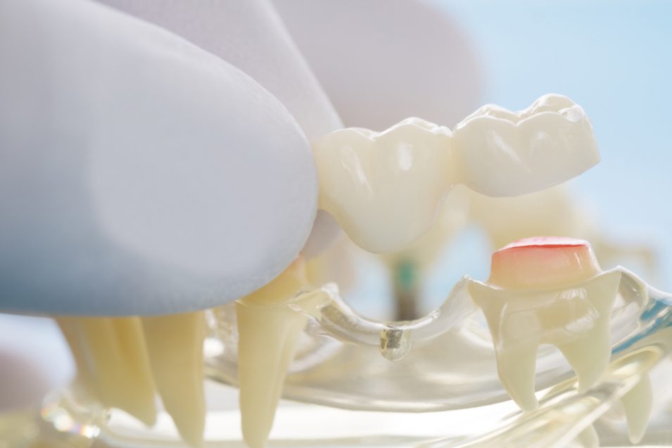 dental bridge placement model