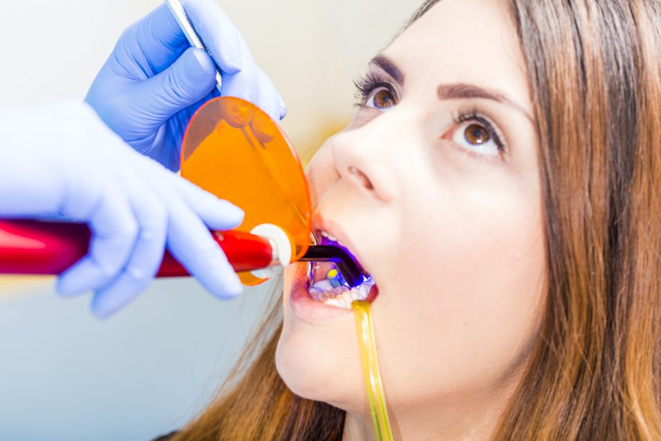 hamilton dentist performing dental bonding procedure