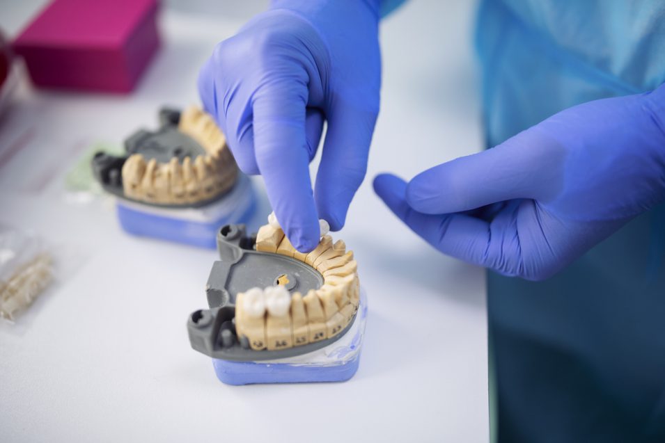 hamilton dentist picking the dental crowns model